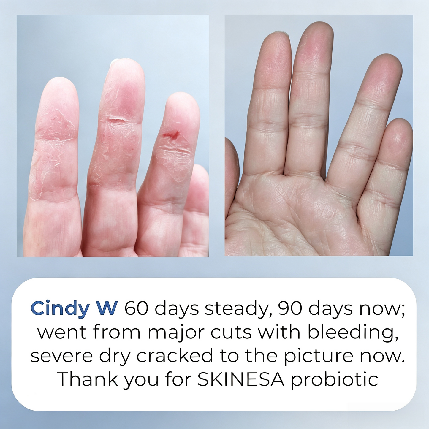 Skinesa Skin Probiotic 30 Servings